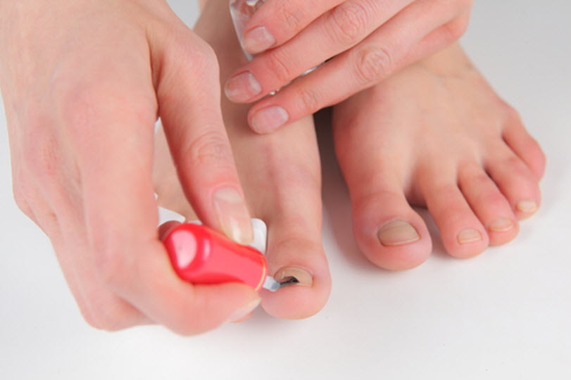 Врач лечение ногтей на ногах. Профилактика грибка ногтей. Профилактика грибковых заболеваний ногтей. Нанесение лака на ногти ног.