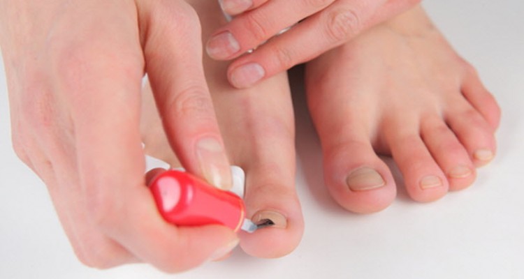 Лечение грибка ногтей ног